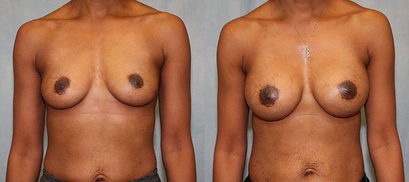 Breast Augmentation Patient 21 Image 3