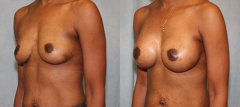 Breast Augmentation Patient 21 Image 2