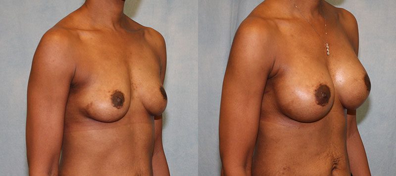 Breast Augmentation Patient 21 Image 1