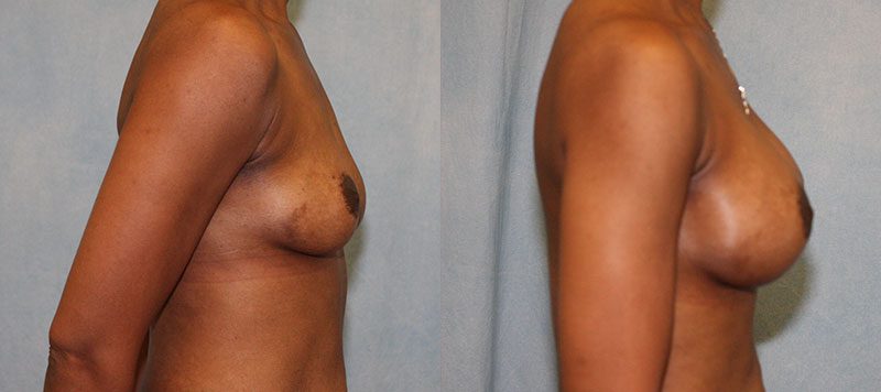 Breast Augmentation Patient 21 Image 0