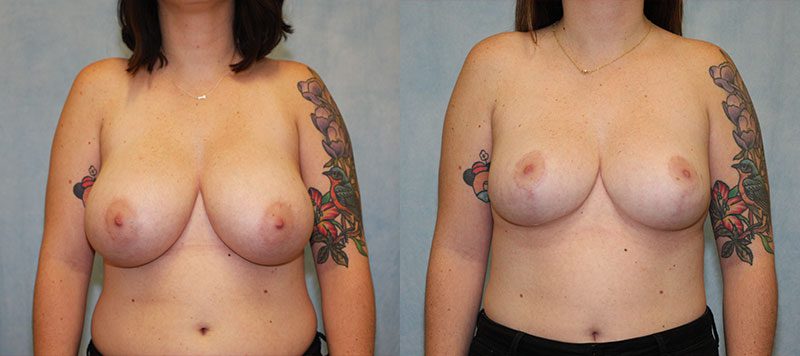 Breast Reduction Patient 250 Image 3