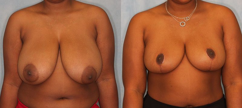 Breast Reduction Patient 1523 Image 3
