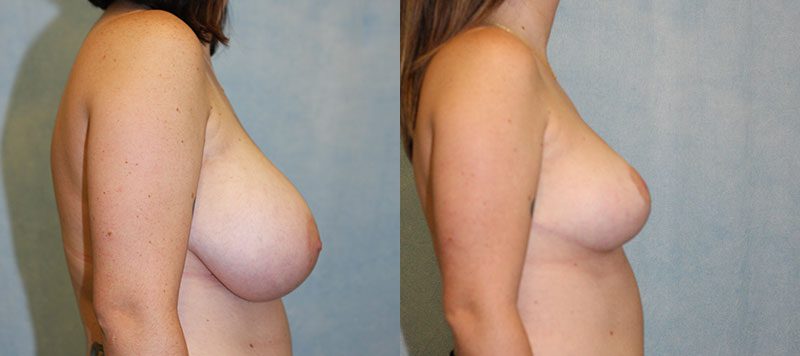 Breast Reduction Patient 250 Image 2