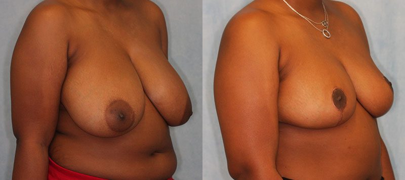 Breast Reduction Patient 7 Image 2