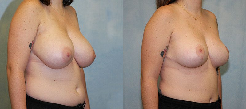 Breast Reduction Patient 6 Image 1