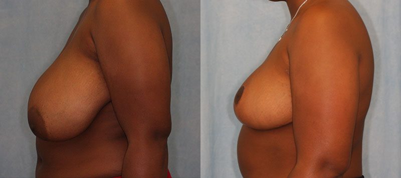Breast Reduction Patient 7 Image 1