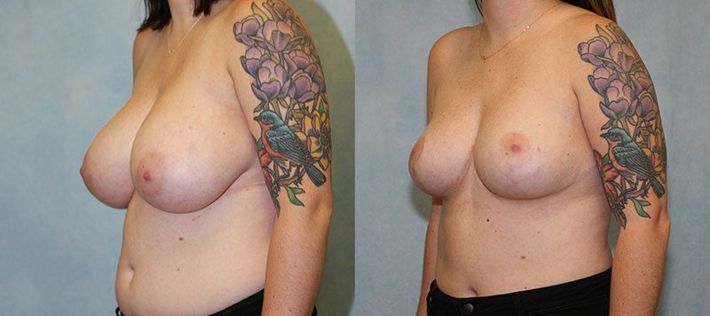 Breast Reduction Patient 250 Image 0