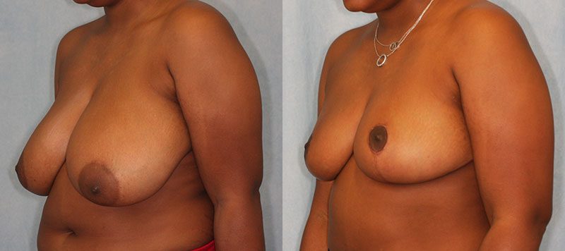 Breast Reduction Patient 7 Image 0