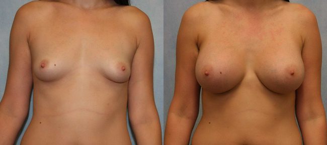 Breast Augmentation Patient 17 Image 4