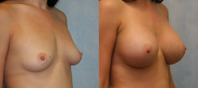 Breast Augmentation Patient 17 Image 3