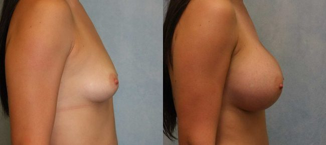 Breast Augmentation Patient 17 Image 2