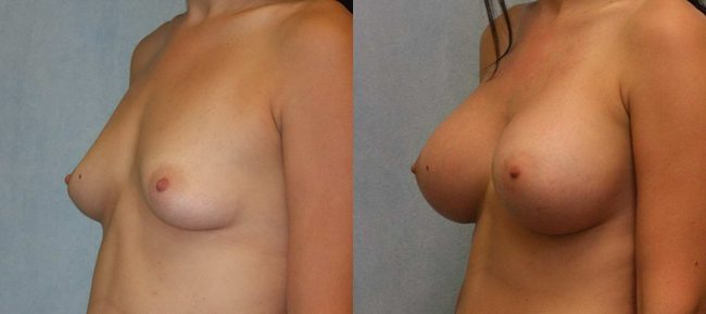 Breast Augmentation Patient 17 Image 1