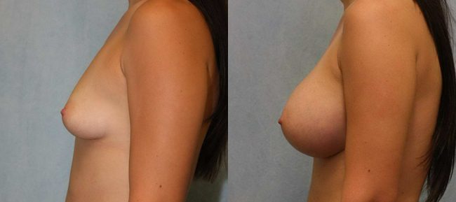 Breast Augmentation Patient 17 Image 0