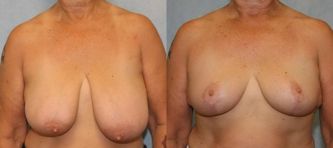 Breast Reduction Patient 1 Image 4