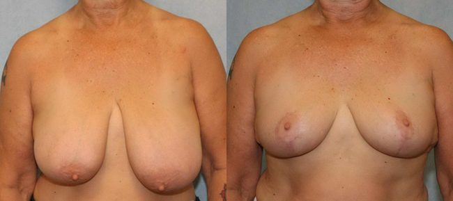 Breast Reduction Patient 1 Image 4