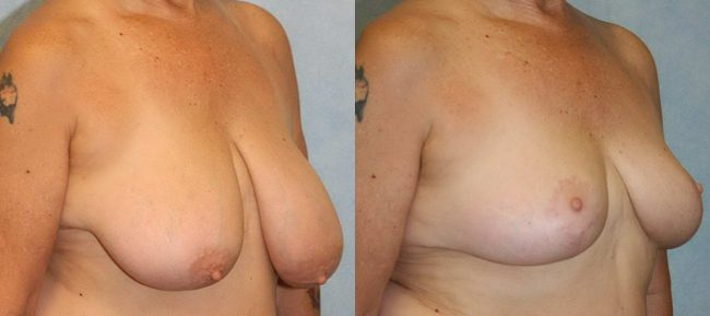 Breast Reduction Patient 1 Image 3