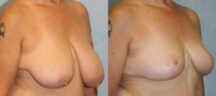 Breast Reduction Before and After Photo 1