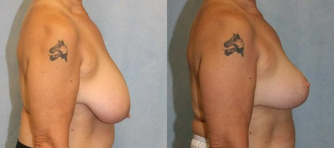 Breast Reduction Patient 1 Image 2