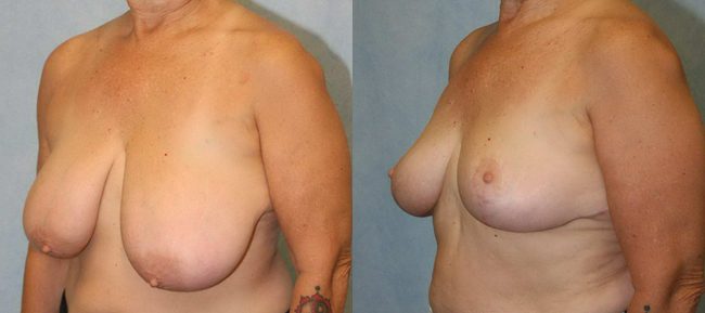 Breast Reduction Patient 1 Image 1