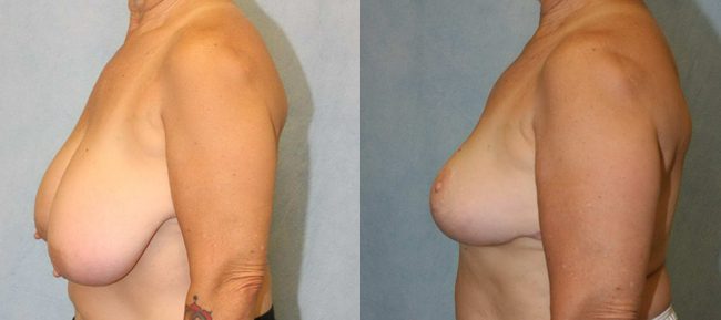 Breast Reduction Patient 1 Image 0