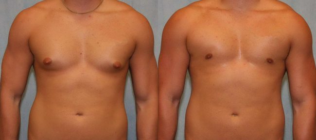 Male Gynecomastia Patient 1 Image 0