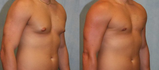 Male Gynecomastia Patient 1 Image 1