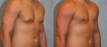 Gynecomastia Before and After Photo 0
