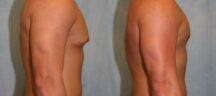 Gynecomastia Before and After Photo 1