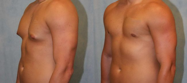 Male Gynecomastia Patient 1 Image 3