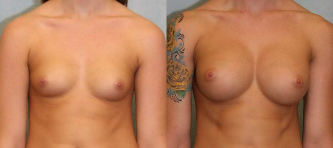 Breast Augmentation Patient 14 Image 4