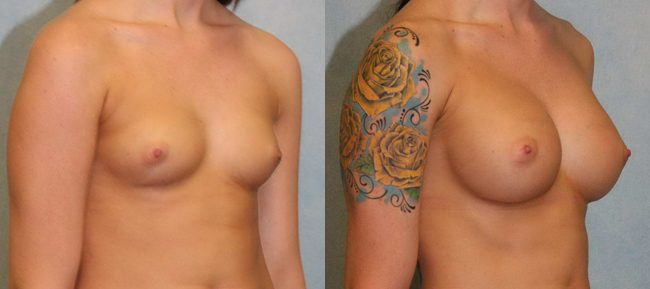 Breast Augmentation Patient 14 Image 3