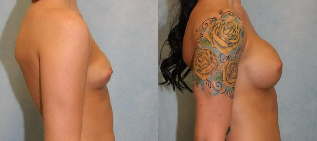 Breast Augmentation Patient 14 Image 2