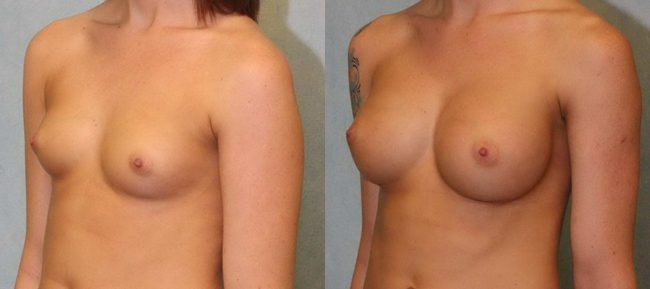 Breast Augmentation Patient 14 Image 1