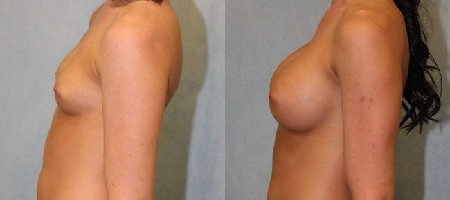 Breast Augmentation Patient 14 Image 0
