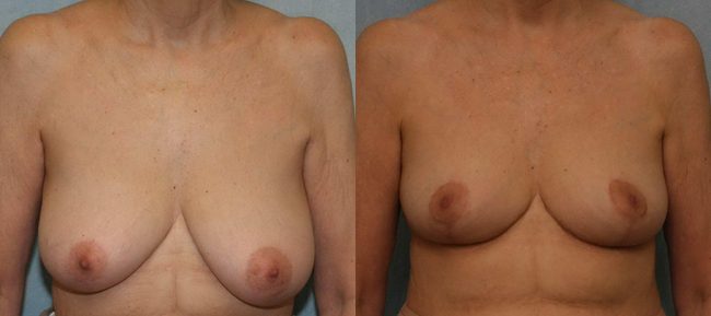 Breast Reduction Patient 5 Image 4