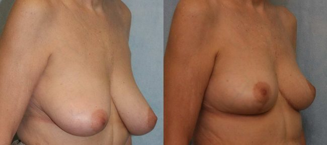 Breast Reduction Patient 5 Image 3