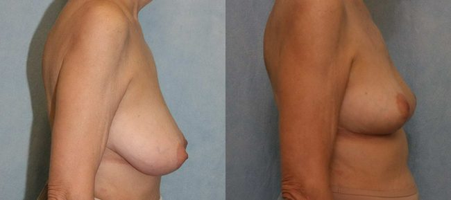 Breast Reduction Patient 5 Image 2