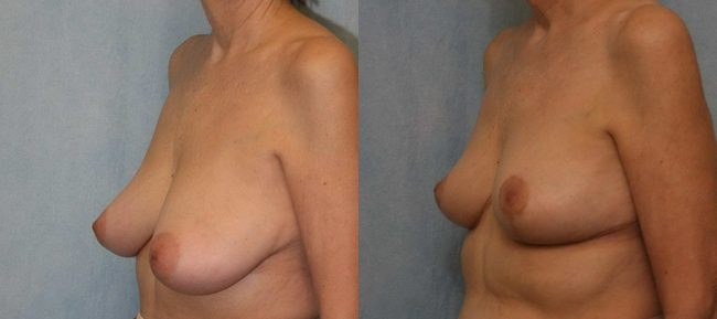 Breast Reduction Patient 5 Image 1
