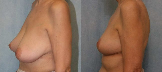 Breast Reduction Patient 5 Image 0