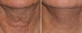 Genius® RF Microneedling Before and After Photo 0