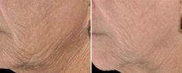 Genius® RF Microneedling Before and After Photo 1