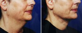 Genius® RF Microneedling Before and After Photo 2