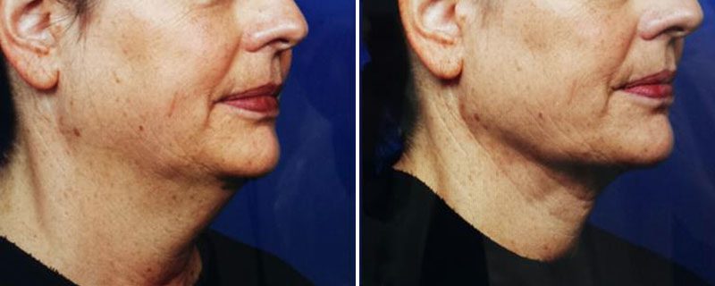 Genius® RF Microneedling Before and After Photo 2