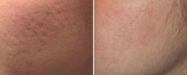Genius® RF Microneedling Before and After Photo 3