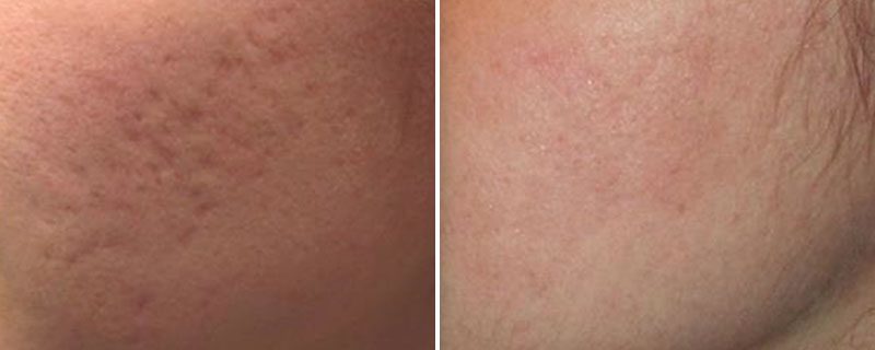 Genius® RF Microneedling Before and After Photo 3