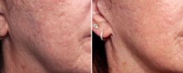 Genius® RF Microneedling Before and After Photo 4
