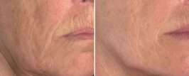 Genius® RF Microneedling Before and After Photo 5