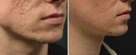 Genius® RF Microneedling Before and After Photo 6
