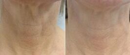Genius® RF Microneedling Before and After Photo 7