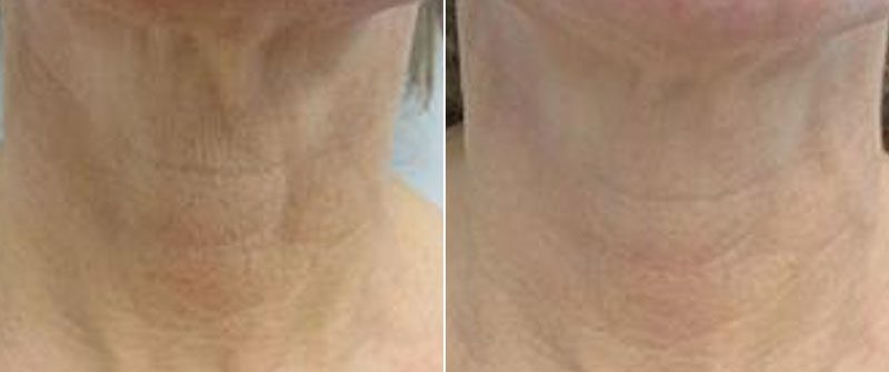 Genius® RF Microneedling Before and After Photo 7